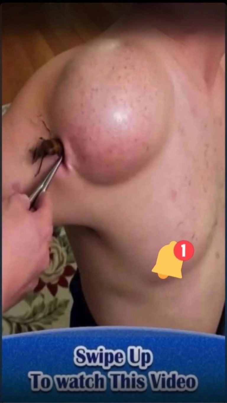 Their acne is severe
