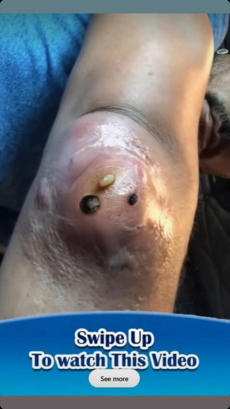 ST, Removal of a fairly large epidermal