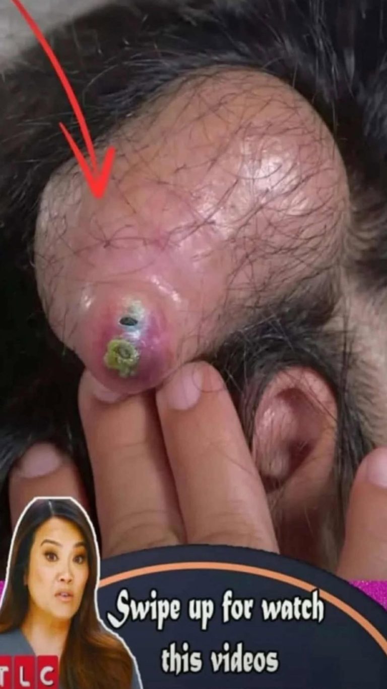 Head Acnes