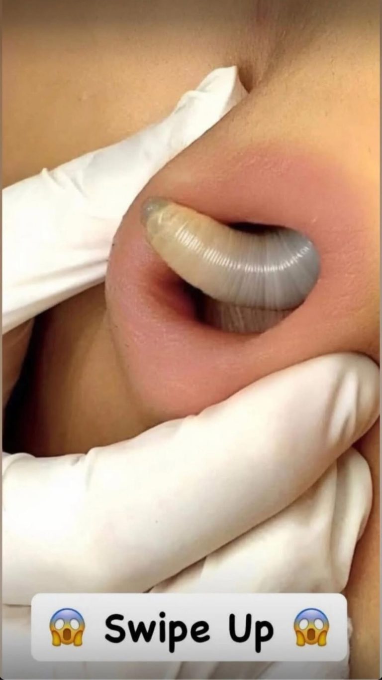 Why You Keep Getting Pimples Inside Your