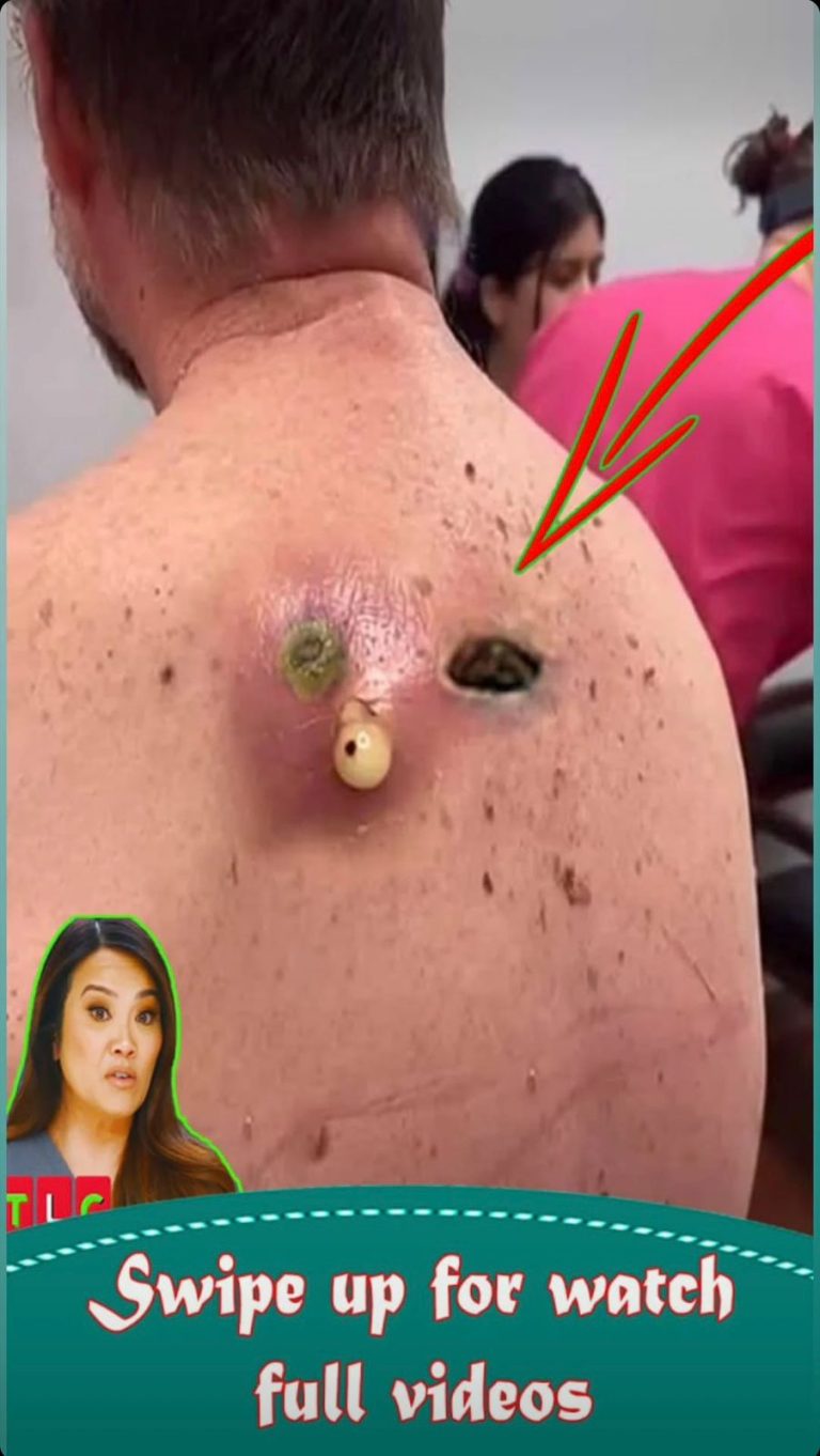How Skin Texture Changes Reveal H
