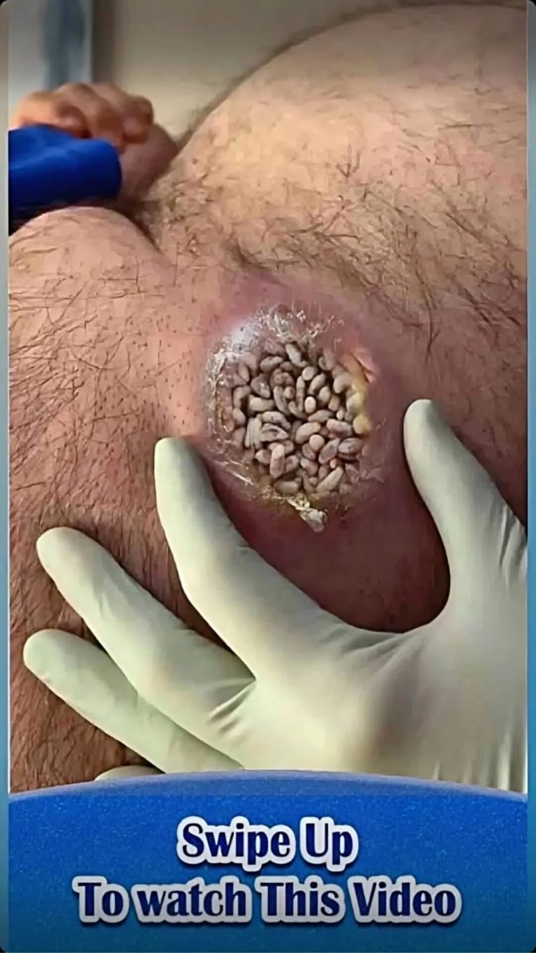 Acne occurs when hair follicles beco