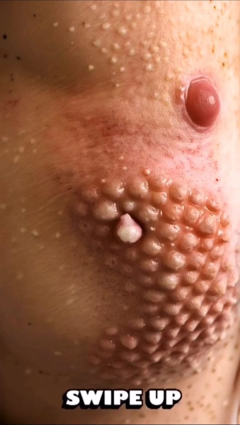 Their acne is severe
