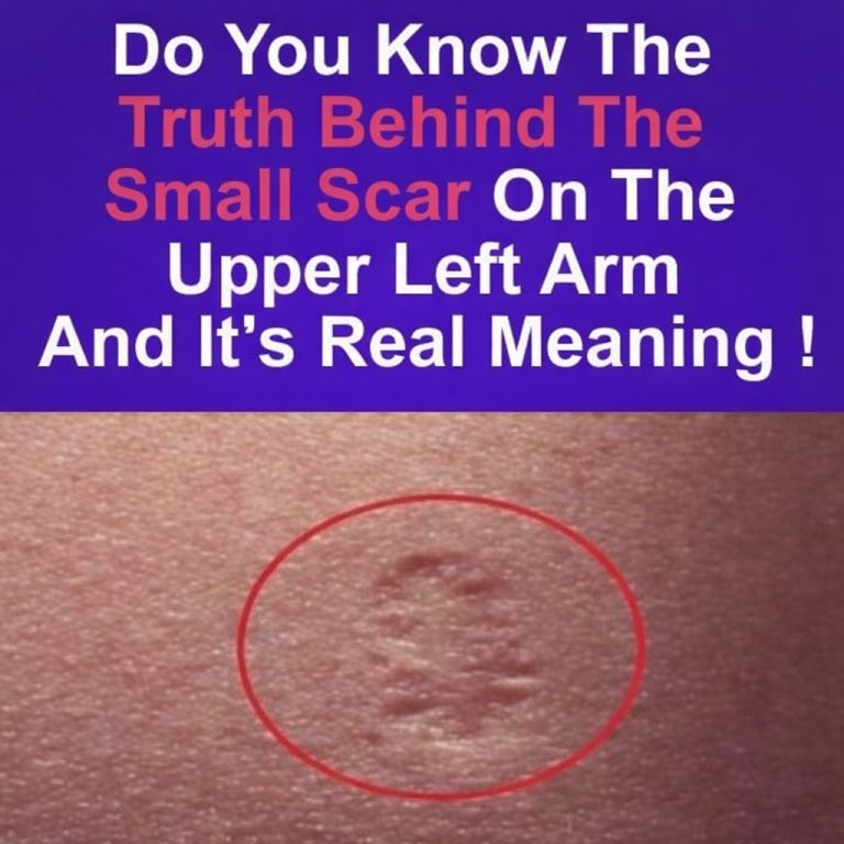 Smallpox vaccine scars: What they look li