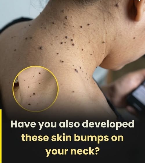 Skin tags can suddenly appear due to friction fro