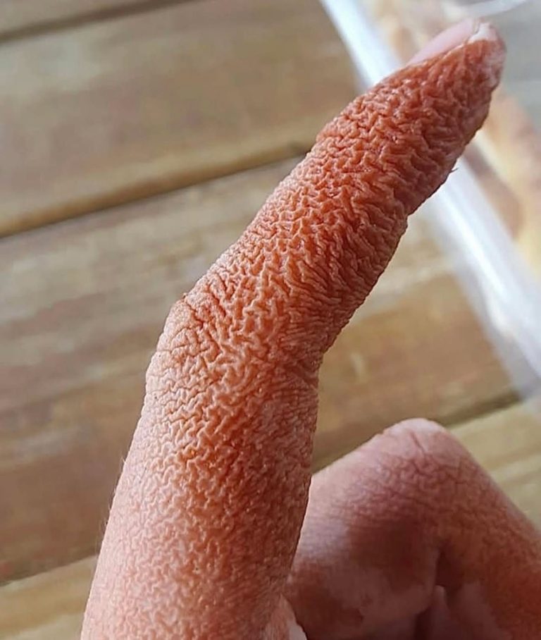 Clinical Presentation and Manageme