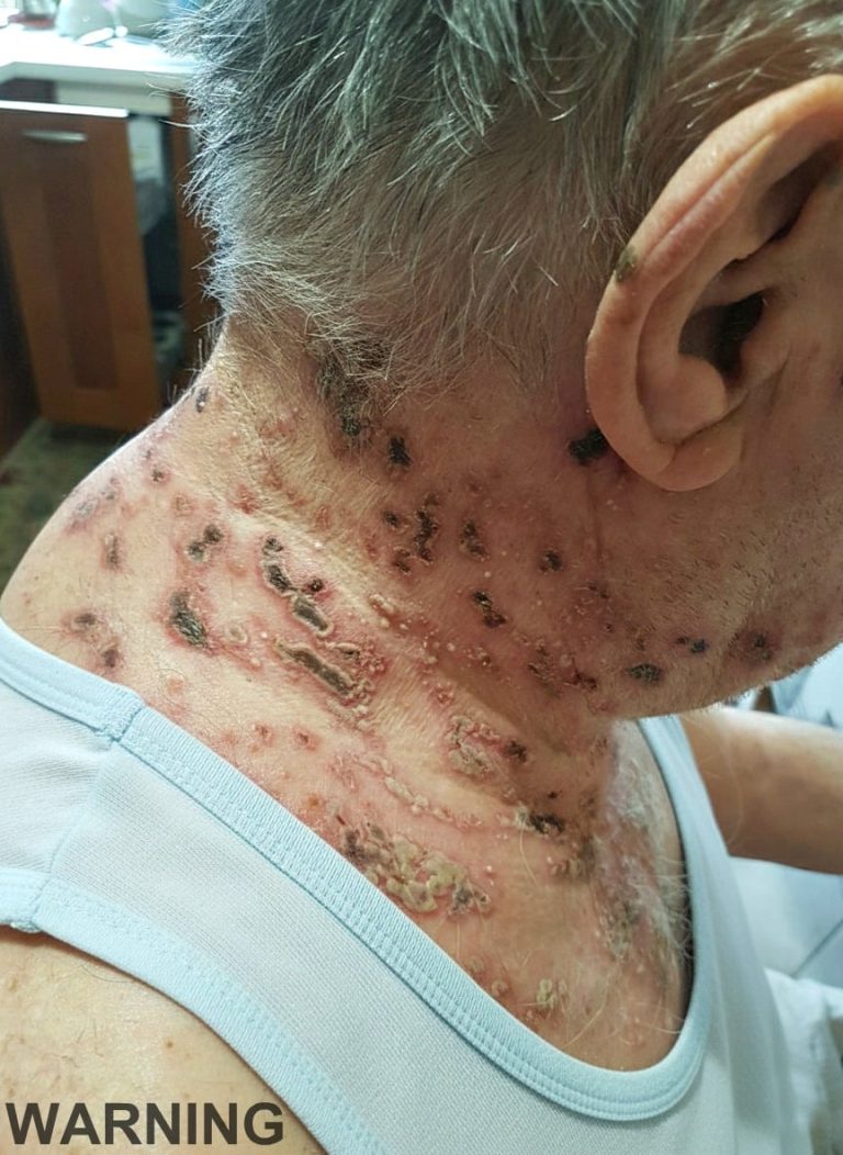 This is the silent disease that is trig