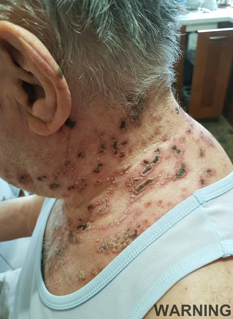 This is the silent disease that is