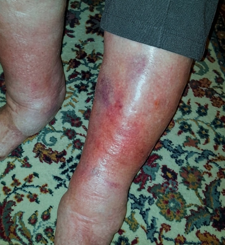 Why a Simple Skin Blemish C