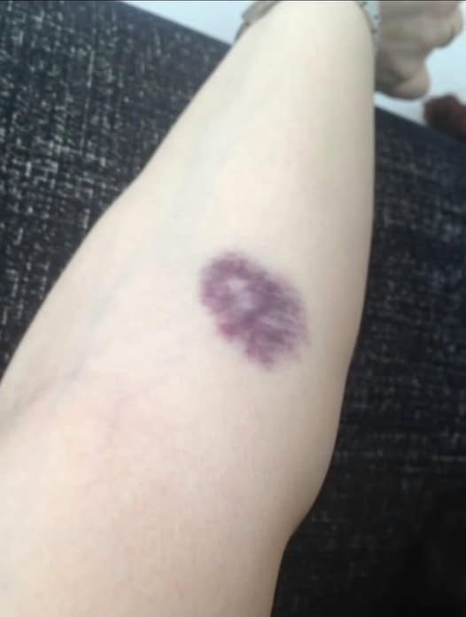 BE CAREFUL, if you get these bruises on your b