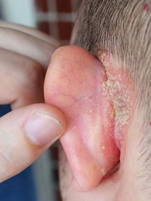 I found a strange patch of skin on my son’s ear this morn