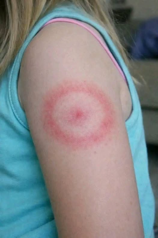 How to identify and cure skin fungu