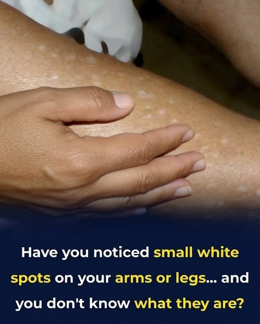 What Vitamin Deficiencies May Lead to White Spots o