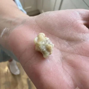 Here’s what you need to know about tonsil 