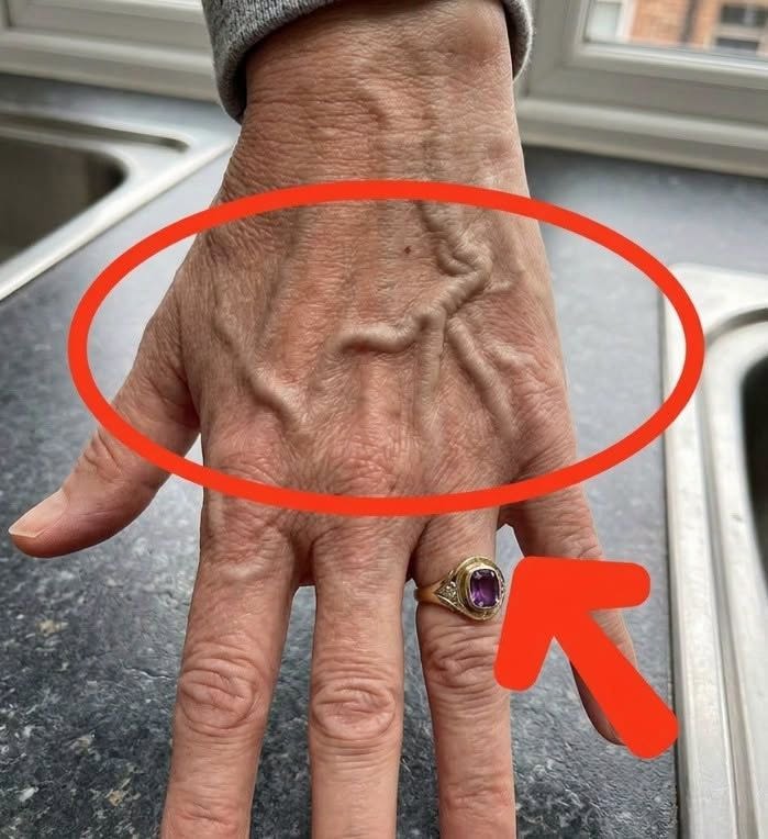 What Bulging Veins Can Mean