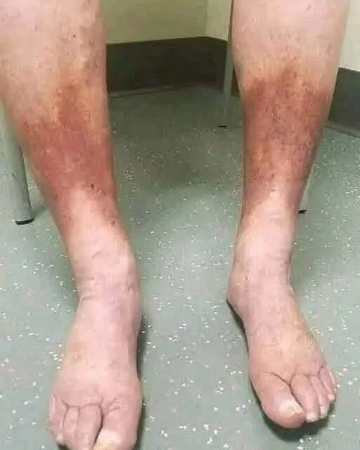 Swollen Feet! Common Causes, Warning Signs, and