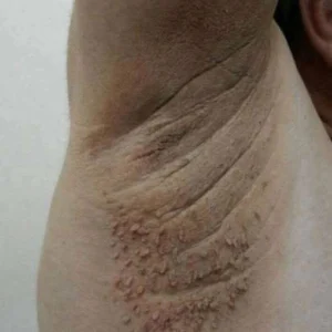 The Shocking Secret Behind Dark Neck Patches: The