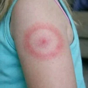 The Red Ring of Terror: Is Your Ch