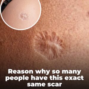 Reason so many people have this exact same scar