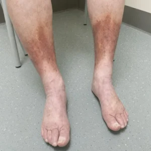 Persistent Leg Swelling and Skin Darkenin
